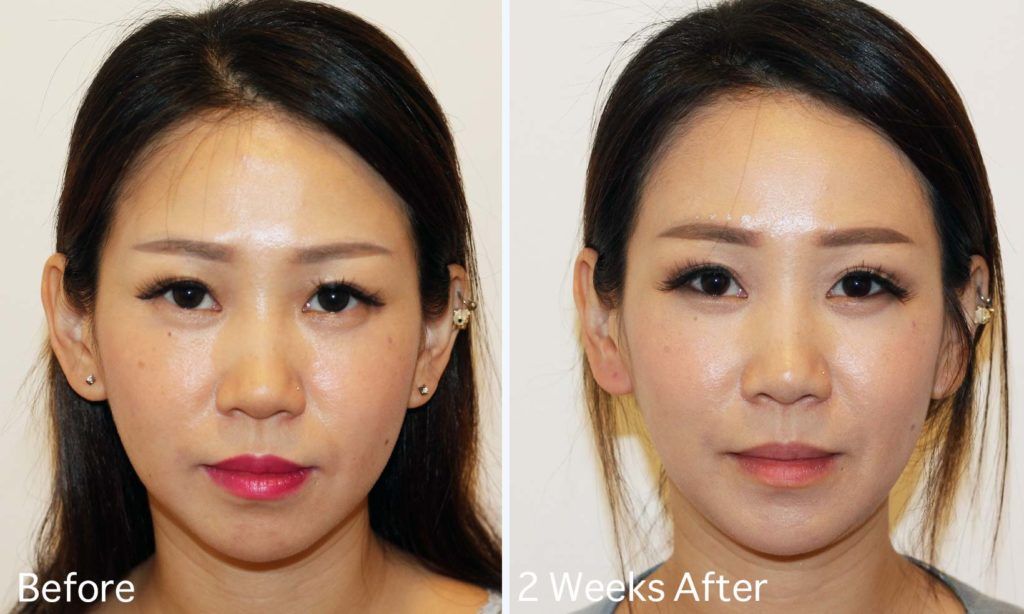 [Blogger Clara] I Tried Threadlift to Get Rid of My Double Chin